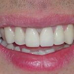 After with porcelain veneers