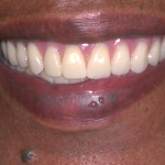 After with full denture