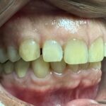 Diastema, gap between the  teeth