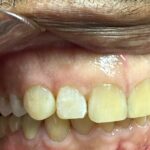 One visit: Gap closed with resin bonding,